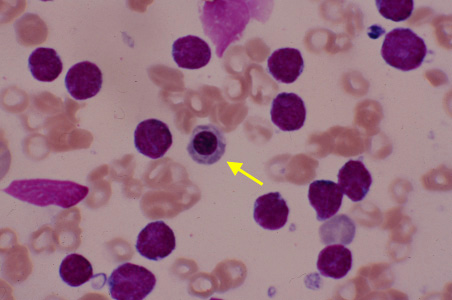 differential cbc smear results weber edu